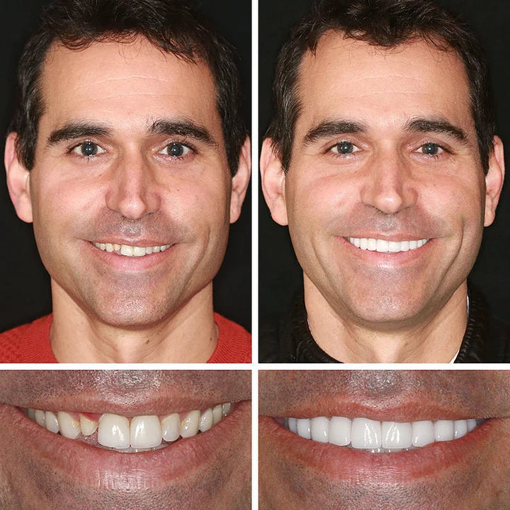🔥Ends Today: 70% OFF! ⏰ 2026 Bestselling Product🦷 Fit for a Fresh Smile, Say Goodbye to Wearing Discomfort!