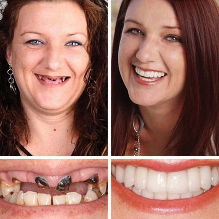 🔥Ends Today: 70% OFF! ⏰ 2026 Bestselling Product🦷 Fit for a Fresh Smile, Say Goodbye to Wearing Discomfort!