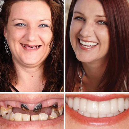 🔥Ends Today: 70% OFF! ⏰ 2026 Bestselling Product🦷 Fit for a Fresh Smile, Say Goodbye to Wearing Discomfort!